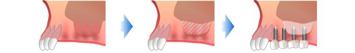 サイナスリフト法、上顎の奥歯の骨再生法